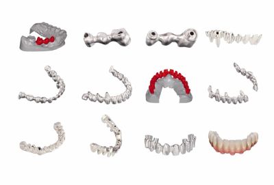 Dental Implantatversorgung in unserer Zahnarztpraxis in Bremen