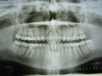 Forschung: schnellere Wundheilung bei Zahnimplantaten